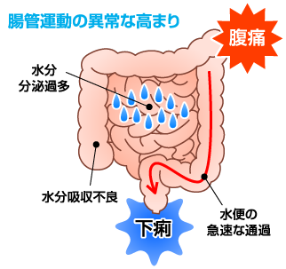 腸管運動の異常な高まり　イメージ