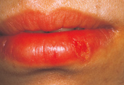 典型的な口唇ヘルペスの症状