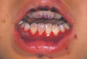 ヘルペス性歯肉口内炎