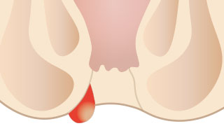 外痔核(いぼ痔)イメージ
