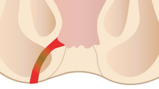 痔ろう(あな痔)イメージ