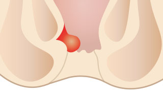内痔核(いぼ痔)イメージ