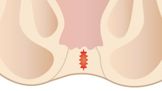 裂肛(きれ痔)イメージ