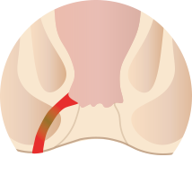 痔ろうイメージ