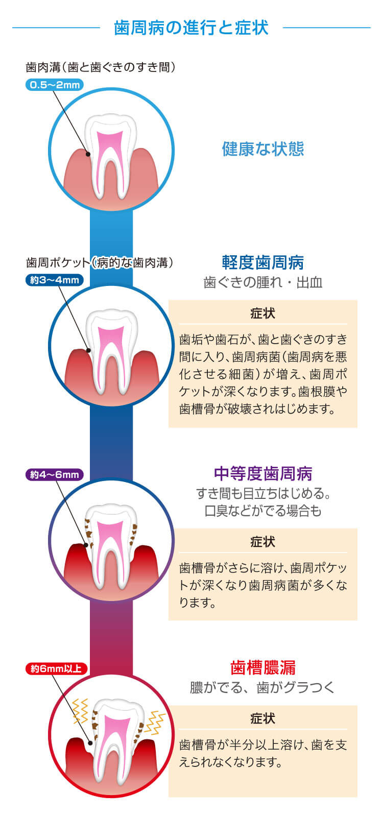 歯周病とは？