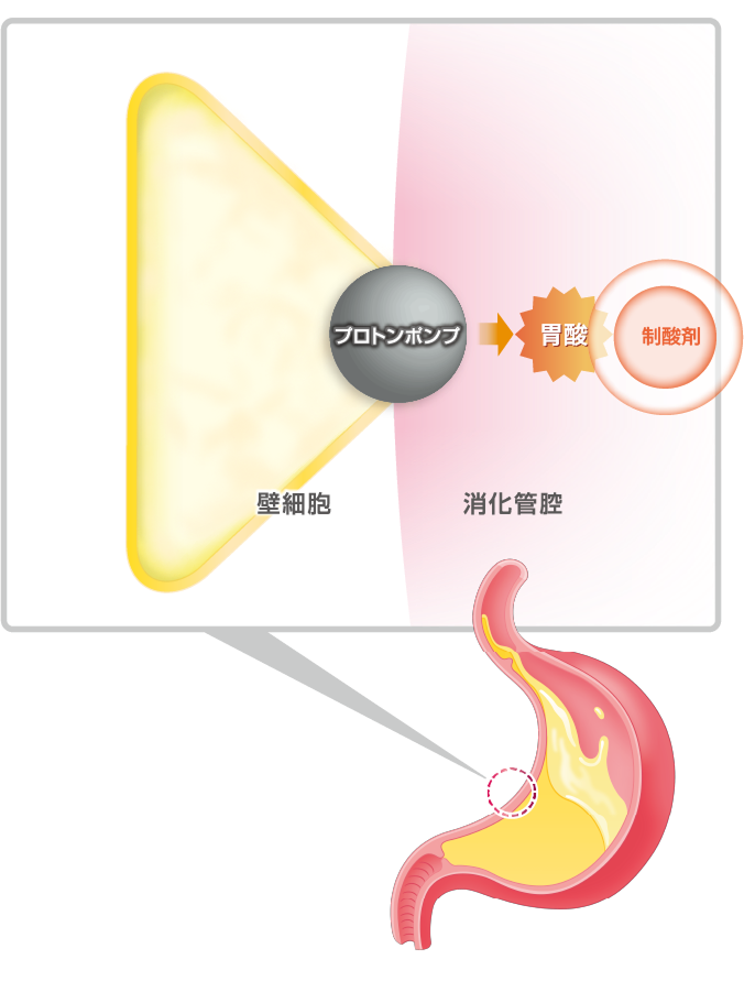 胃の中の“酸”を中和イメージ（スマホ）