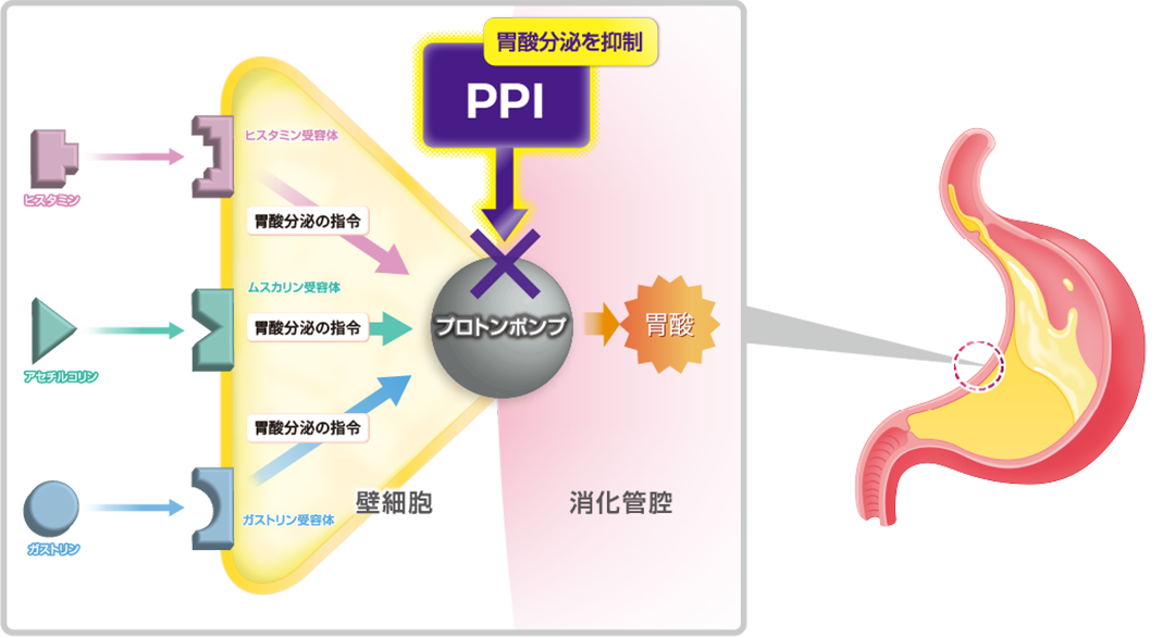 PPIが過剰な胃酸を抑制するイメージ