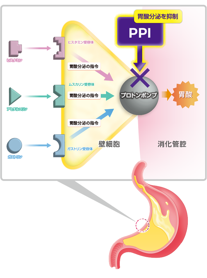 PPIが過剰な胃酸を抑制するイメージ（スマホ）