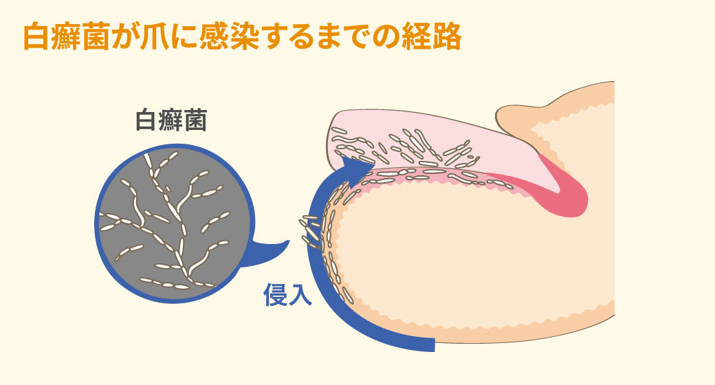 白癬菌が爪に感染するまでの経路