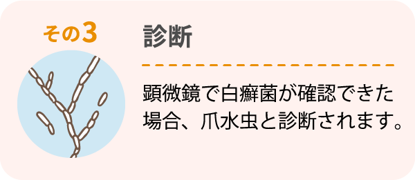 その3 診断 顕微鏡で白癬菌が確認できた場合、爪水虫と診断されます。