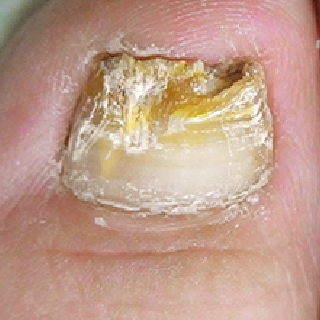 爪水虫が原因で、爪が濁り、厚く、ボロボロになっている写真