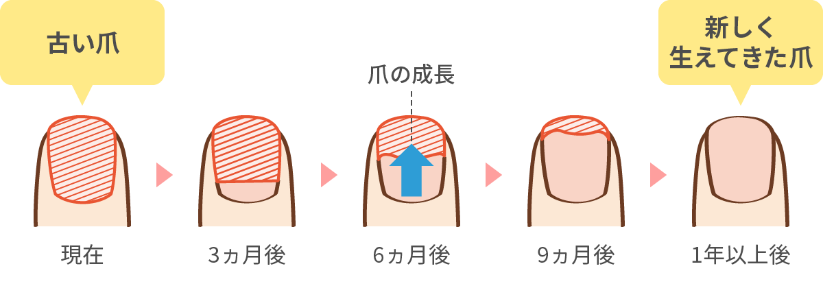 足の爪の生え変わりのイメージ